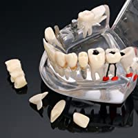 Modelo de dientes de enfermedad de implante dental con puente de restauración Modelo de ortodoncia de maloclusión para…